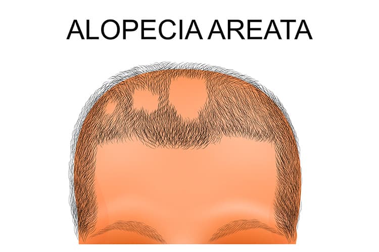 Kreisrunder Haarausfall (Alopecia areata) - eine Erkrankung, die Rätsel aufgibt