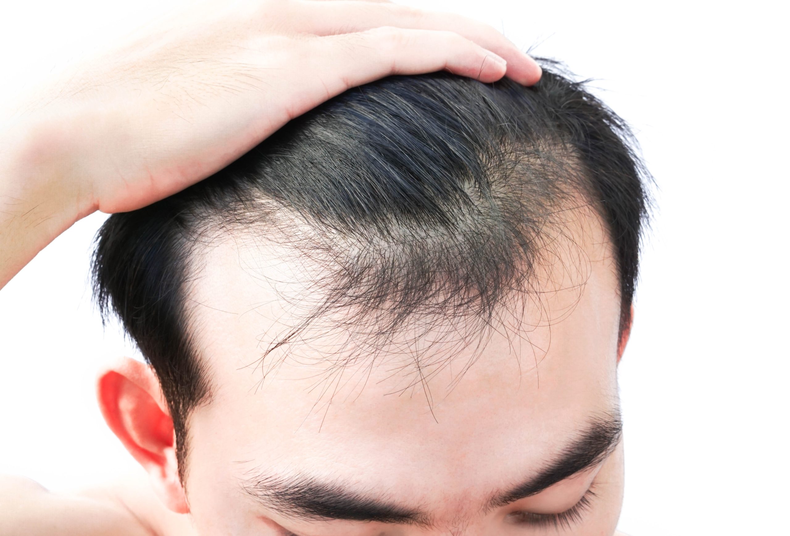 Was kann gegen Haarausfall helfen?